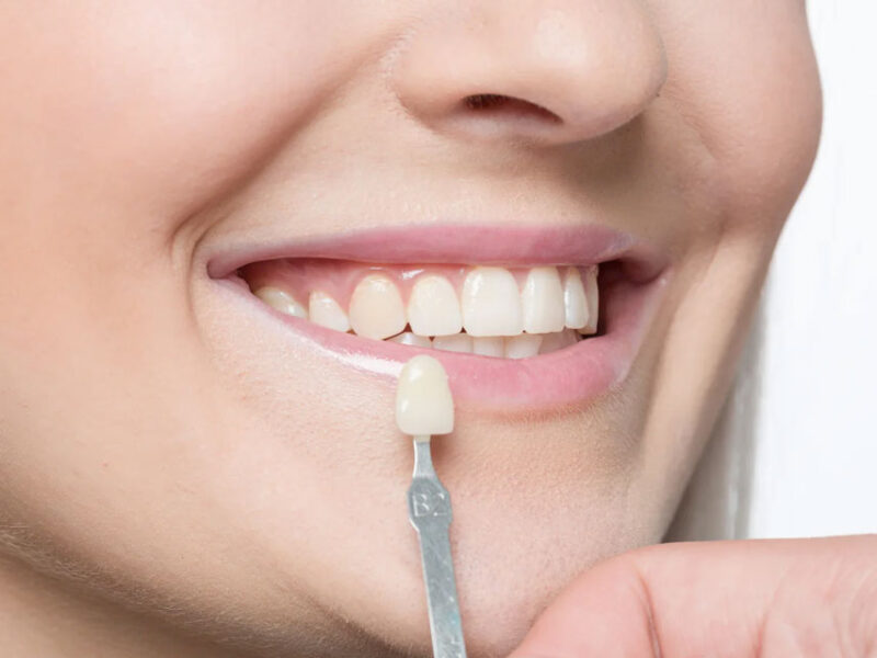 img-chawlaorthodontics-blog-13