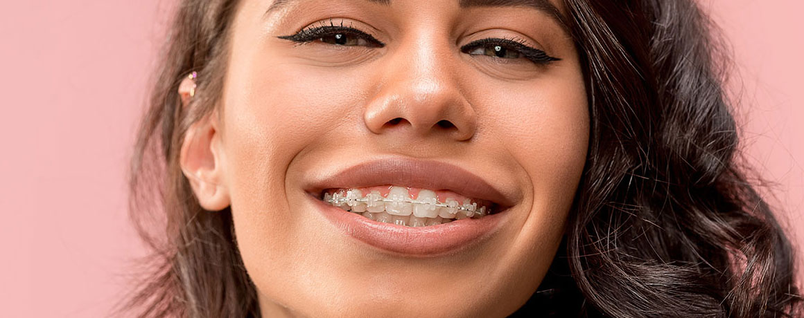 img-chawlaorthodontics-treatment-braces-ceramicbraces-02