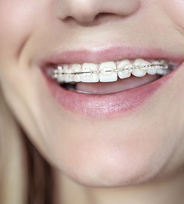 img-chawlaorthodontics-treatment-braces-ceramicbraces-03