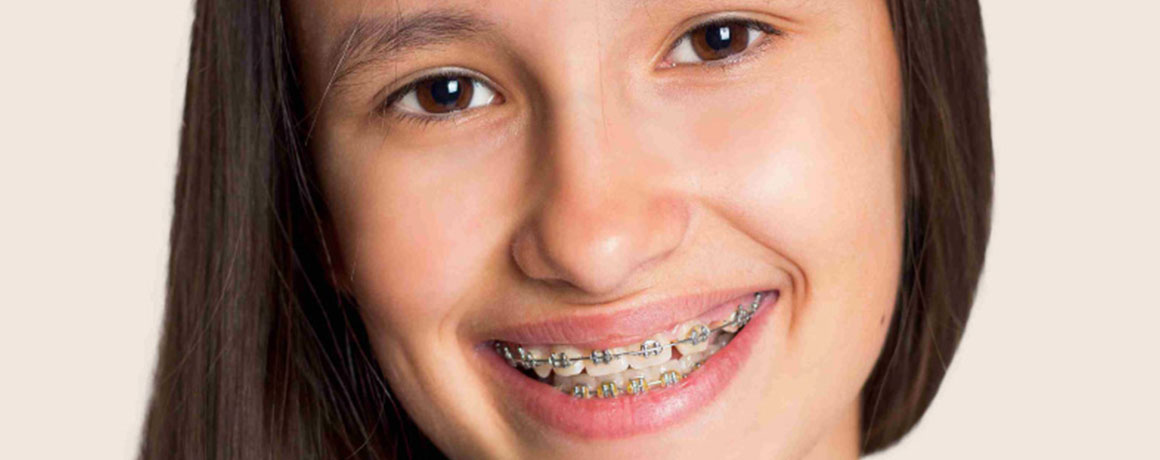 img-chawlaorthodontics-treatment-braces-metalbraces-02 img-chawlaorthodontics-treatment-braces-metalbraces-02