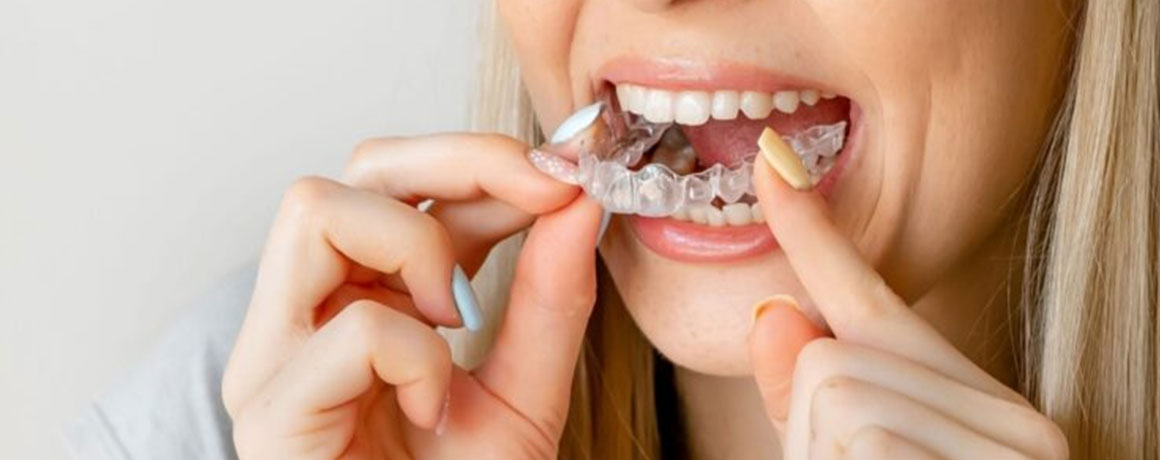 img-smilemaintenance-retainerassurance-02