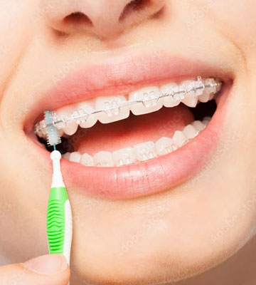 Clear-Ceramic-Braces