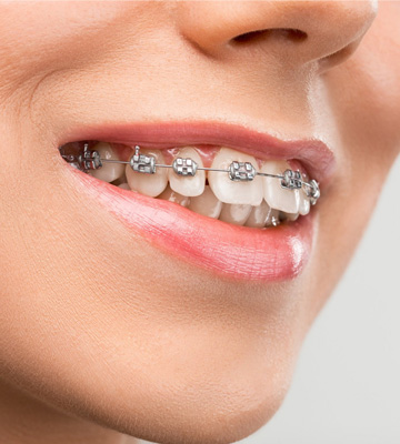 Traditional-Metal-Braces