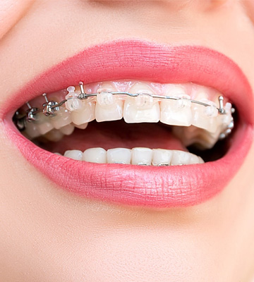 Self-Ligating-Braces